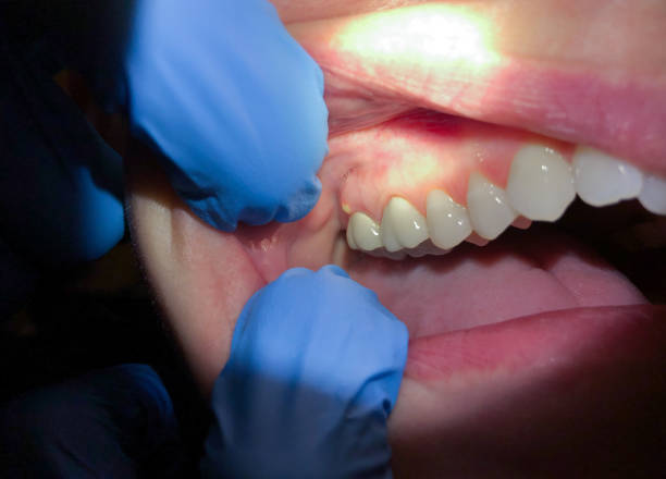 Best Emergency Dentist for Knocked-Out Tooth in Plattsburg, MO
