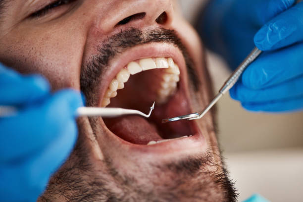 Best Broken or Cracked Tooth Emergency Dentist in Plattsburg, MO